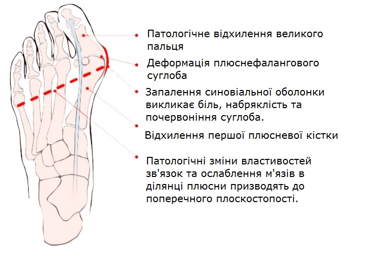 Кісточка на нозі