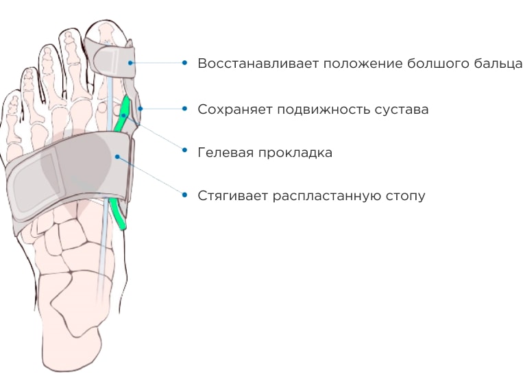 Лечение косточки на ногах