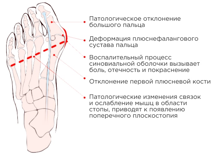 Косточка на ноге